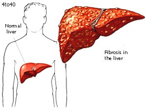 Cirrhosis of Liver Disease