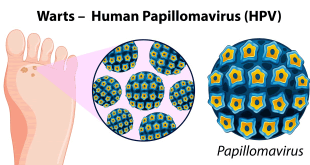 Warts: Ayurvedic Home Remedy For Warts