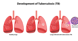 Tuberculosis: Natural Ayurvedic Home Remedies For TB