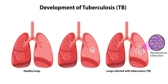 Tuberculosis: Natural Ayurvedic Home Remedies For TB
