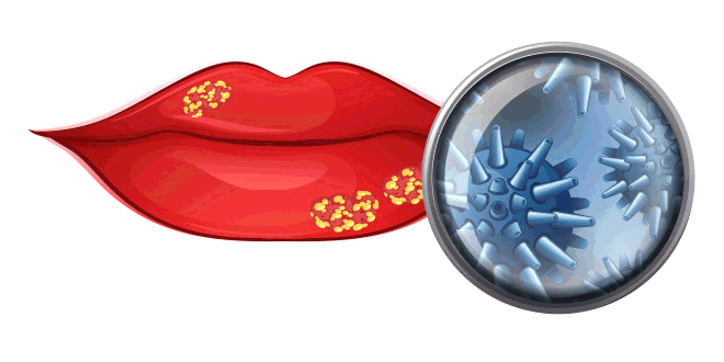 Herpes: Ayurvedic Home Remedies For Herpes