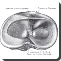 What is Meniscus Tear?