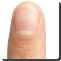 What causes the white marks which sometimes appear on our finger nails?