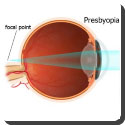 What is presbyopia? Which lens is used to correct it?