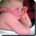 What is scarlet fever?