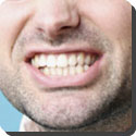 What is bruxism?