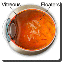 What are floaters?