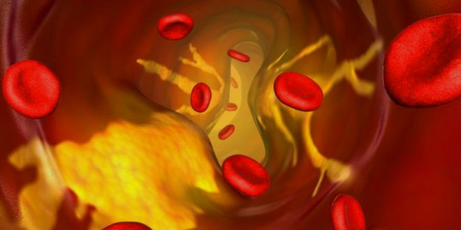 High Blood Cholesterol