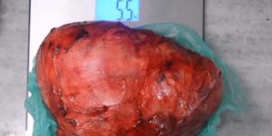 India World Record: Heaviest kidney tumor removed
