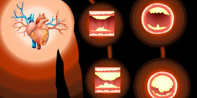 बैड कोलैस्ट्रोल