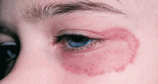 Fungal Infection (Dadru)