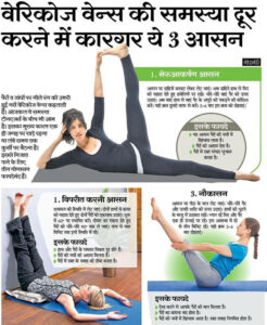 Yoga postures that Can help cure Varicose Veins