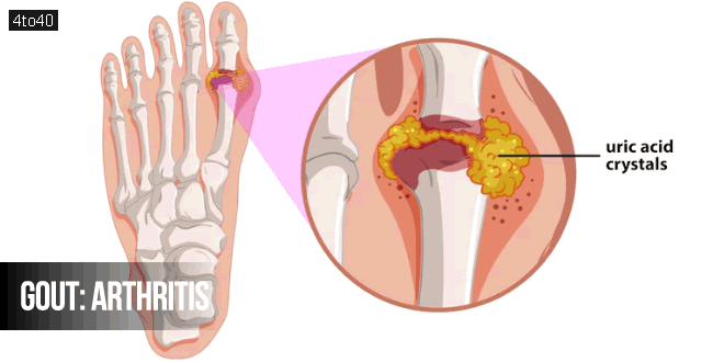 Gout: Arthritis Cause, Symptoms, Diagnose & Treatment Related Questions