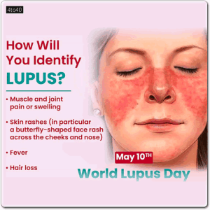 On this World Lupus Day (May 10th), let’s spread awareness about this often misunderstood autoimmune disease. Early diagnosis can make a big difference!