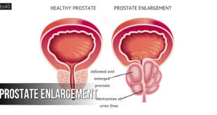 पौरुष ग्रन्थि की वृद्धि: Prostate Enlargement