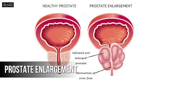 पौरुष ग्रन्थि की वृद्धि: Prostate Enlargement